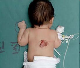 Un Bebe nace con un pene en la espalda