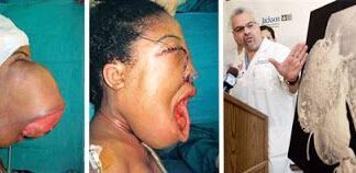 Los 16 Crecimientos Humanos más Horrorosos de Todos los Tiempo (NSFW)