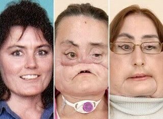 Presentan a mujer con transplante de rostro. (VIDEO)