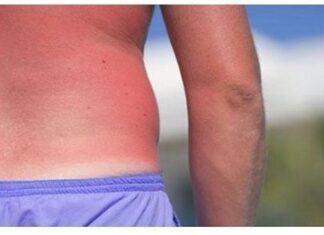 Tratamiento para las quemaduras solares
