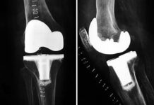 Vídeo de la Operación de Prótesis de Rodilla