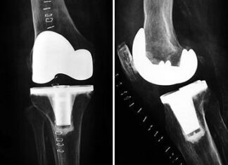 Vídeo de la Operación de Prótesis de Rodilla
