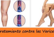 Novedosos Tratamientos para las Várices tratamiento contra las varices
