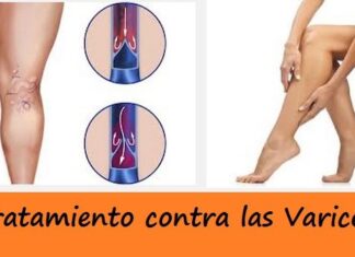 Novedosos Tratamientos para las Várices tratamiento contra las varices
