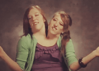 Dos Siamesas Unidas en el Mismo Cuerpo Dos Siamesas Unidas en el Mismo Cuerpo