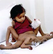 Nace una bebe con 4 brazos y 4 piernas.